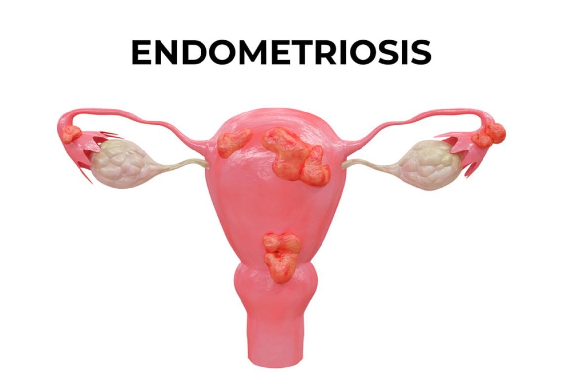 endometriosis-1